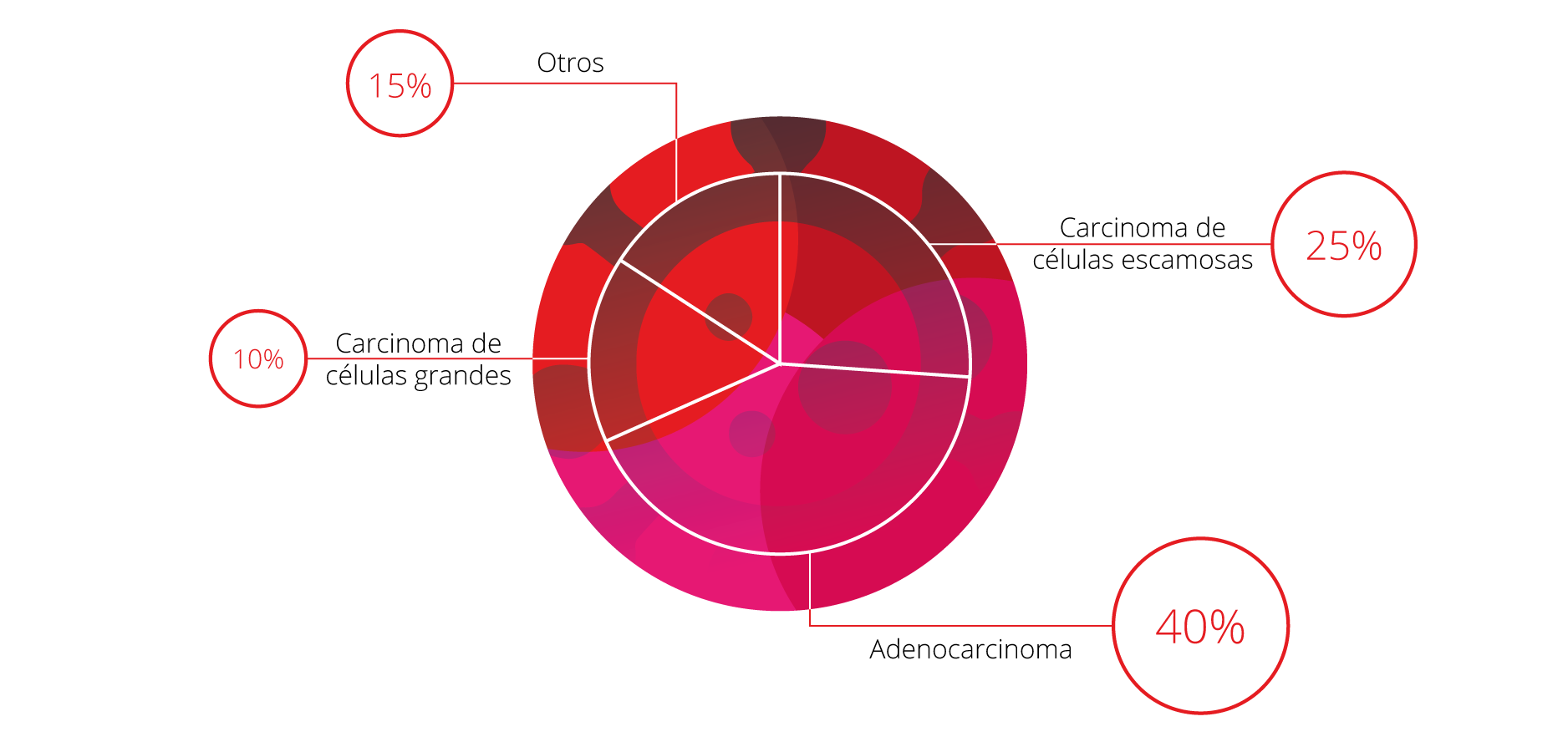Subtipos cáncer de pulmón de células de pulmón no pequeñas o no microcítico (CPNM)