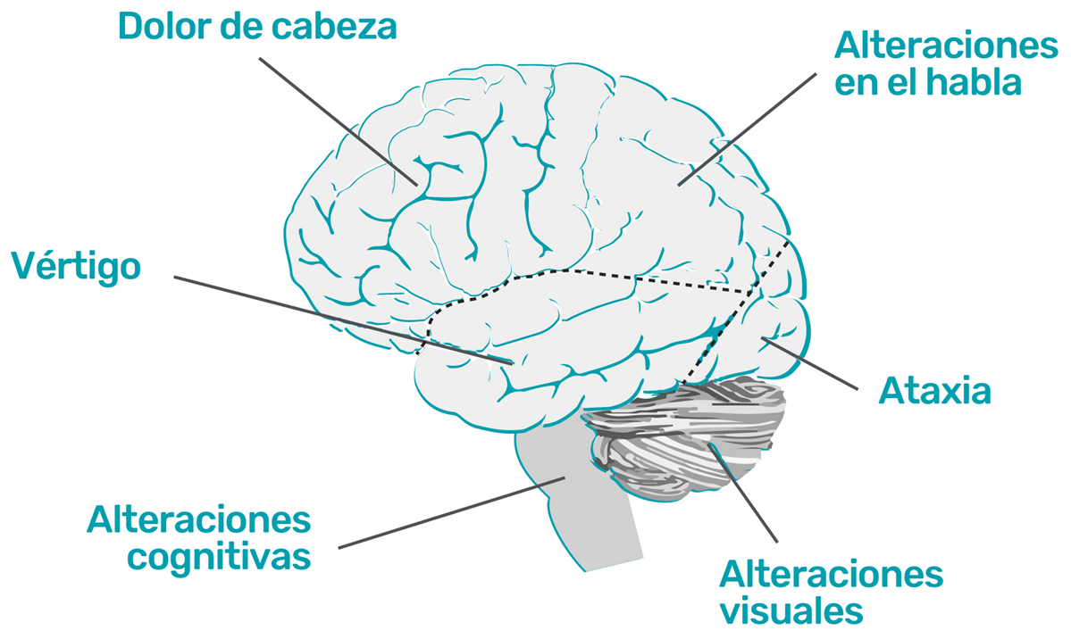 Alteraciones más frecuentes según la localización de la metástasis cerebral