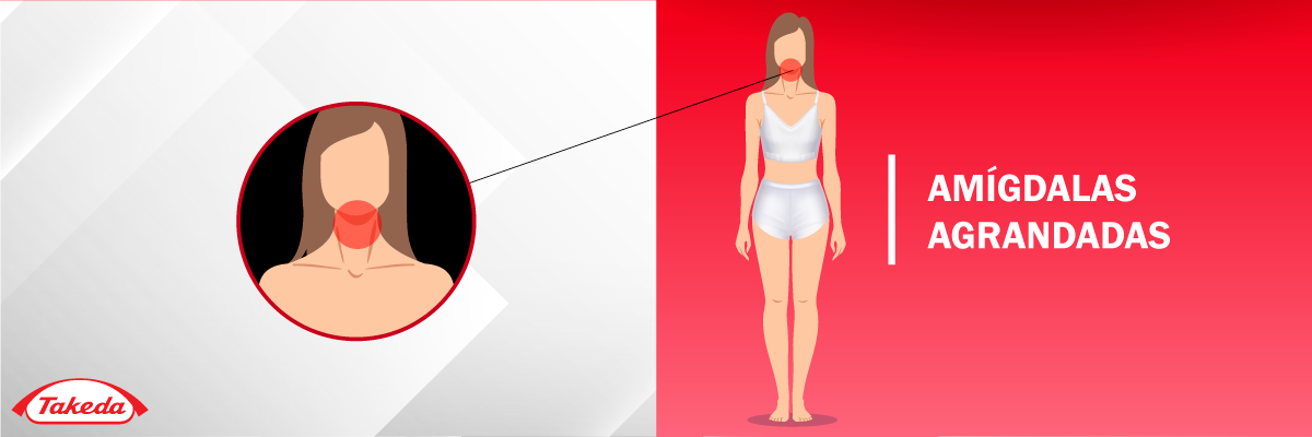 Amígdalas agrandadas.