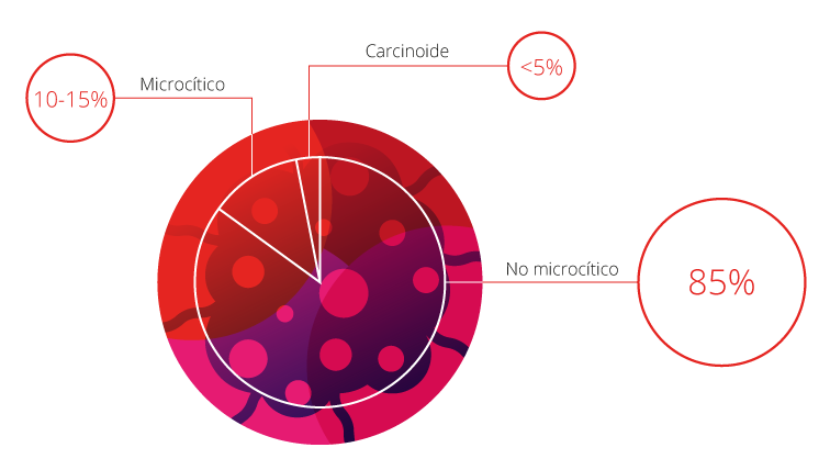 Tipos de cáncer de pulmón
